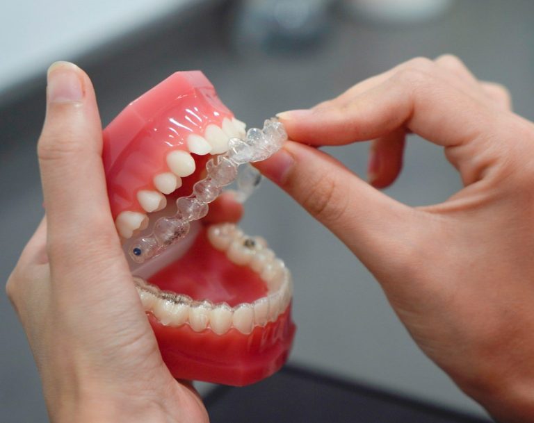 Leistung Aligner-Schienen – die nahezu unsichtbare Zahnkorrektur